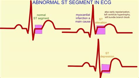 ekg readings abnormal|Abnormal EKG: Results, causes, and treatment.